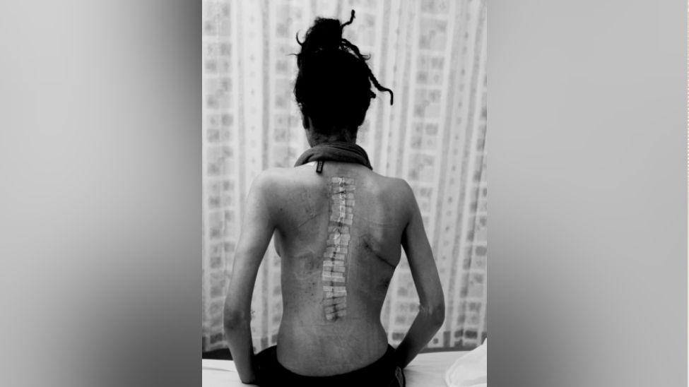 A black and white photo shows a woman sitting on a hospital bed, with a stitched down her back. She is wearing trousers and a scarf but no top. The photo is taken from the back and her face is not visible.