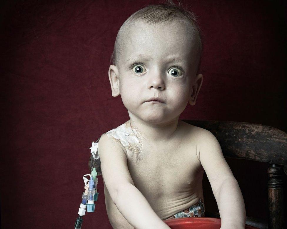 A young boy with tubes attached to his body stares at the camera