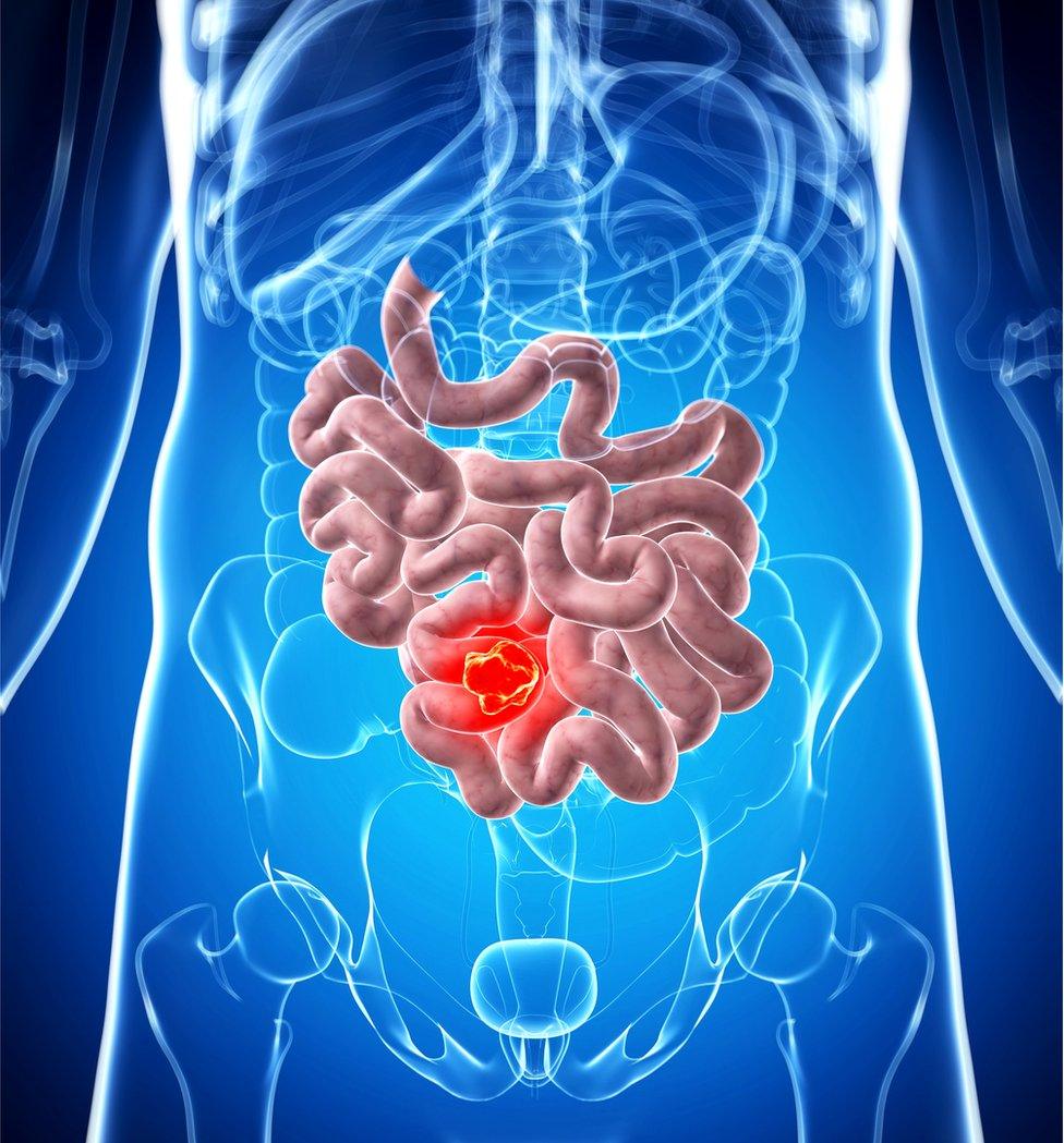 illustration of bowel cancer