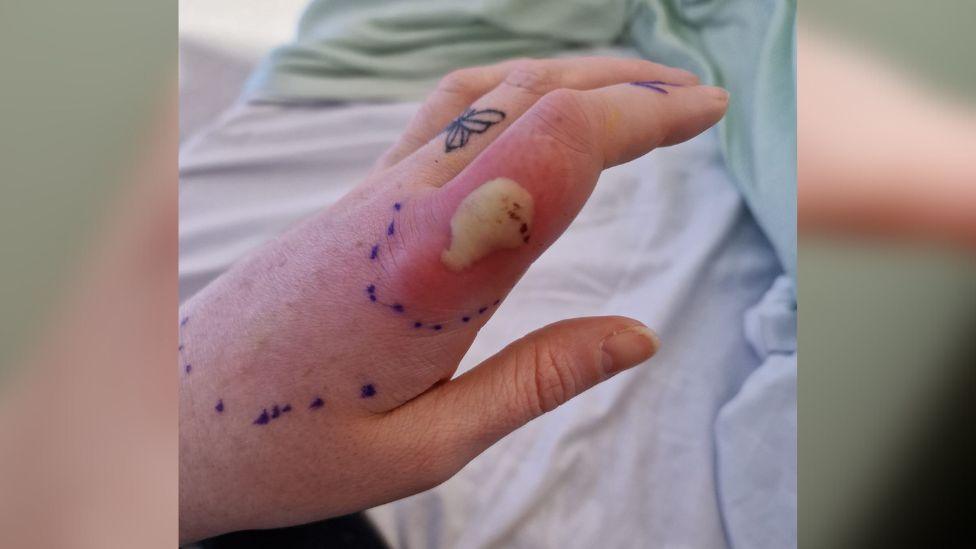 Woman's hand with large infected spider bite on finger