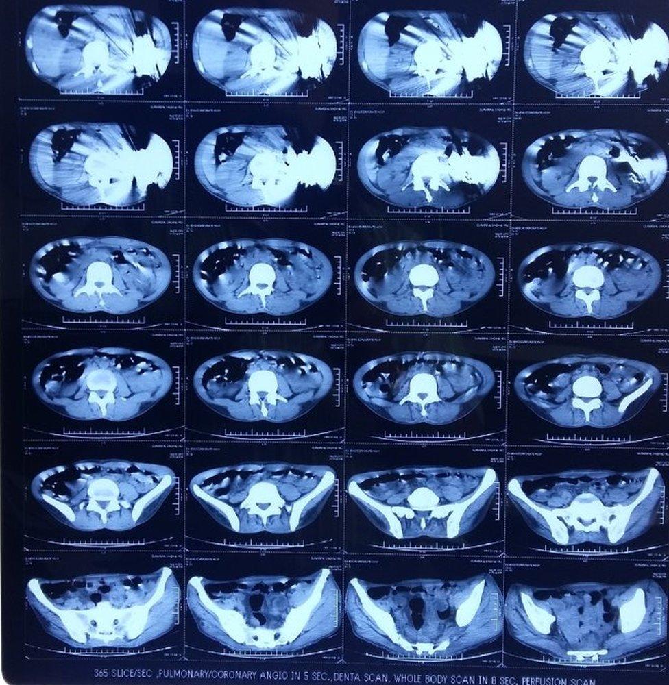 CT scans showed 40 knives in the man's stomach