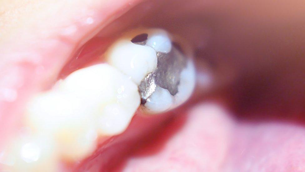 Dental amalgam filling