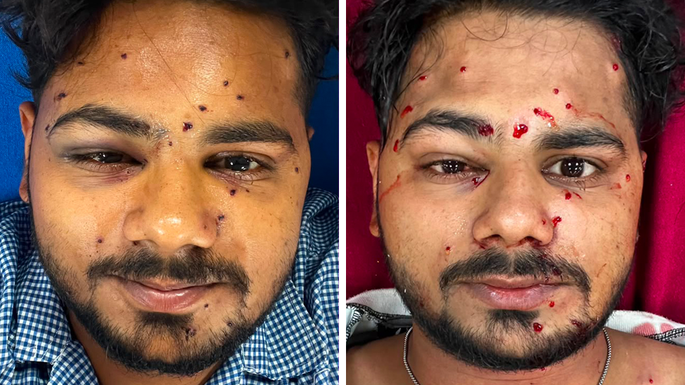 Shaikh Irshad Mansoori said scans showed he had more than 40 pellets in his body
