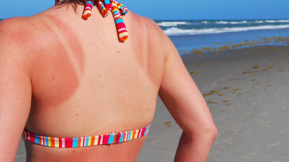 Woman with sunburnt back