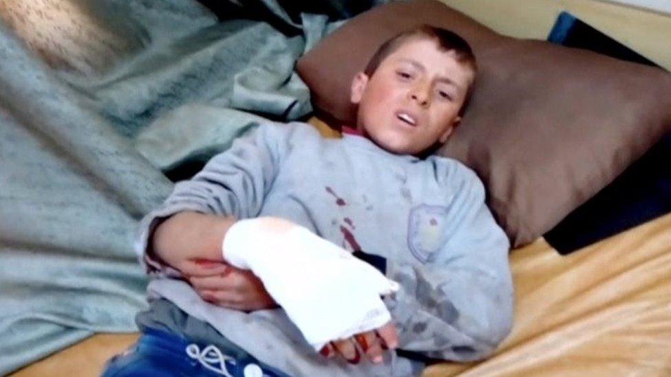 A boy lies on a bed with an injured hand after what is said to be a missile attack on a hospital in Azaz (15 February 2016)