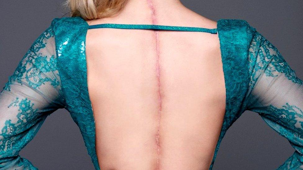 Victoria poses in an open ball gown showing a 25 inch scar from her surgeries down her spine