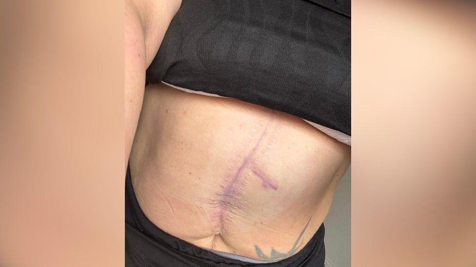 A picture of Laura's stomach showing a scar from the knife wound she received.