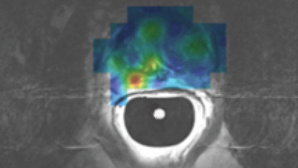 Scan from Europe's first patient to undergo a prostate hyper-polarised MRI