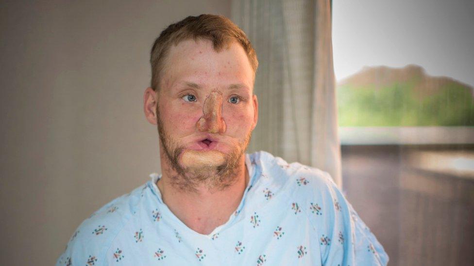 Andy Sandness before his surgery. His face is heavily scarred and his mouth is only an inch wide. He wears a prosthetic nose.