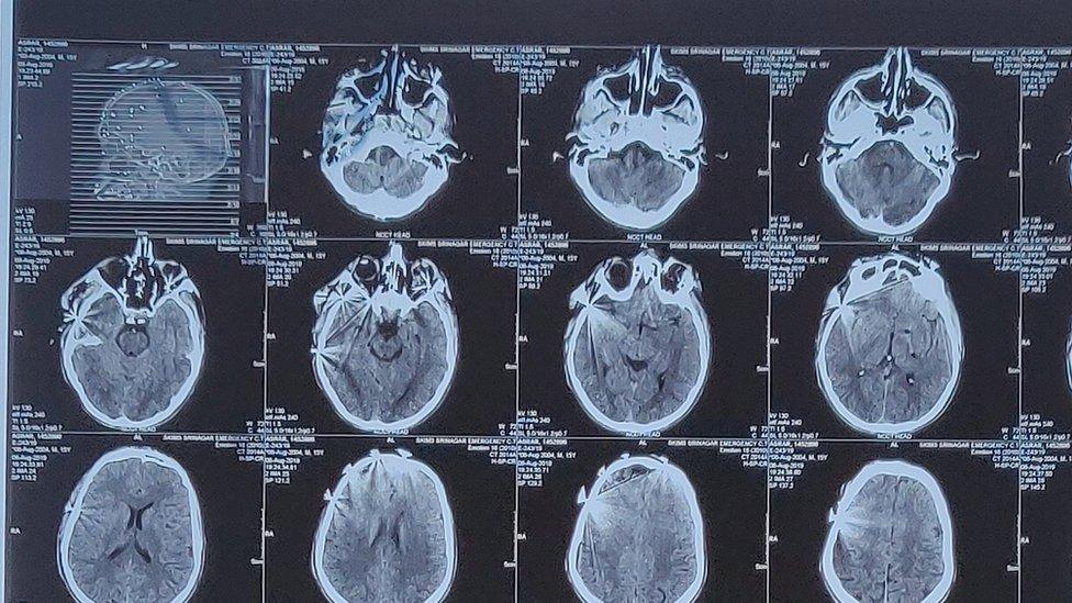 A photo of an X-ray of Asrar's skull, with pellets visible in the top left hand corner of the scan