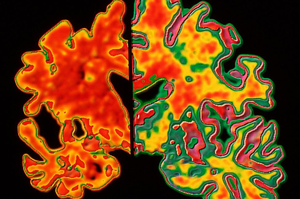 Comparison of normal and affected brain