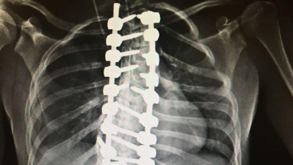 X-ray of rods in Megan's spine