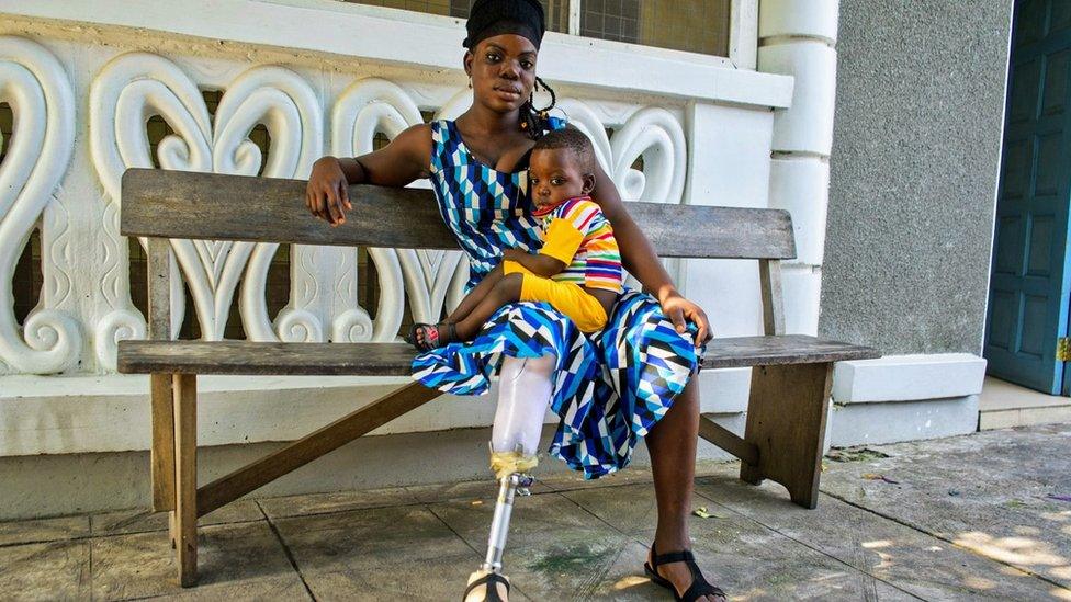 Woman using a donated prosthetic leg