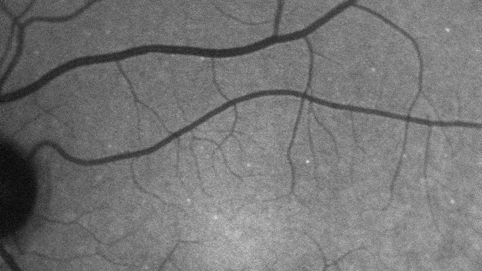 Glaucoma: Researchers use a fluorescence technique to show up each "sick" retinal nerve cell