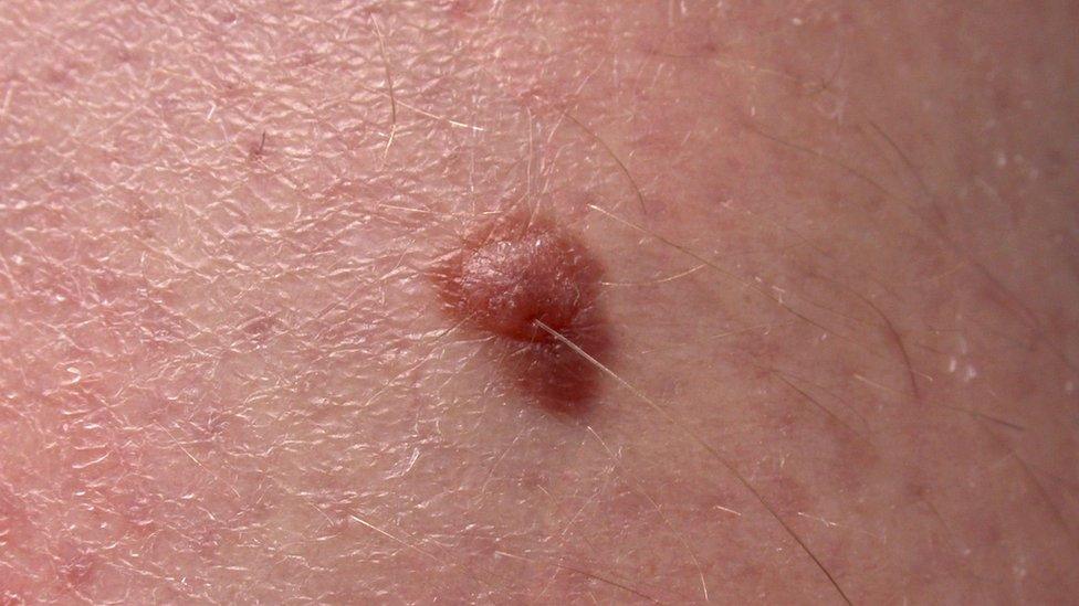 A melanoma tumour