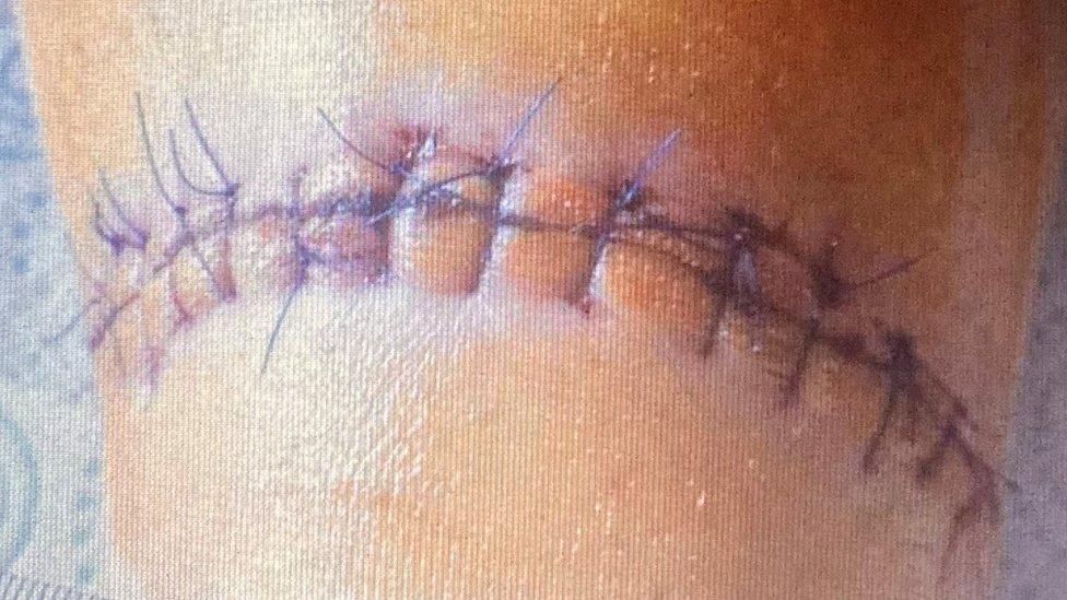 Close-up of stitches on a bite wound on Romily's leg