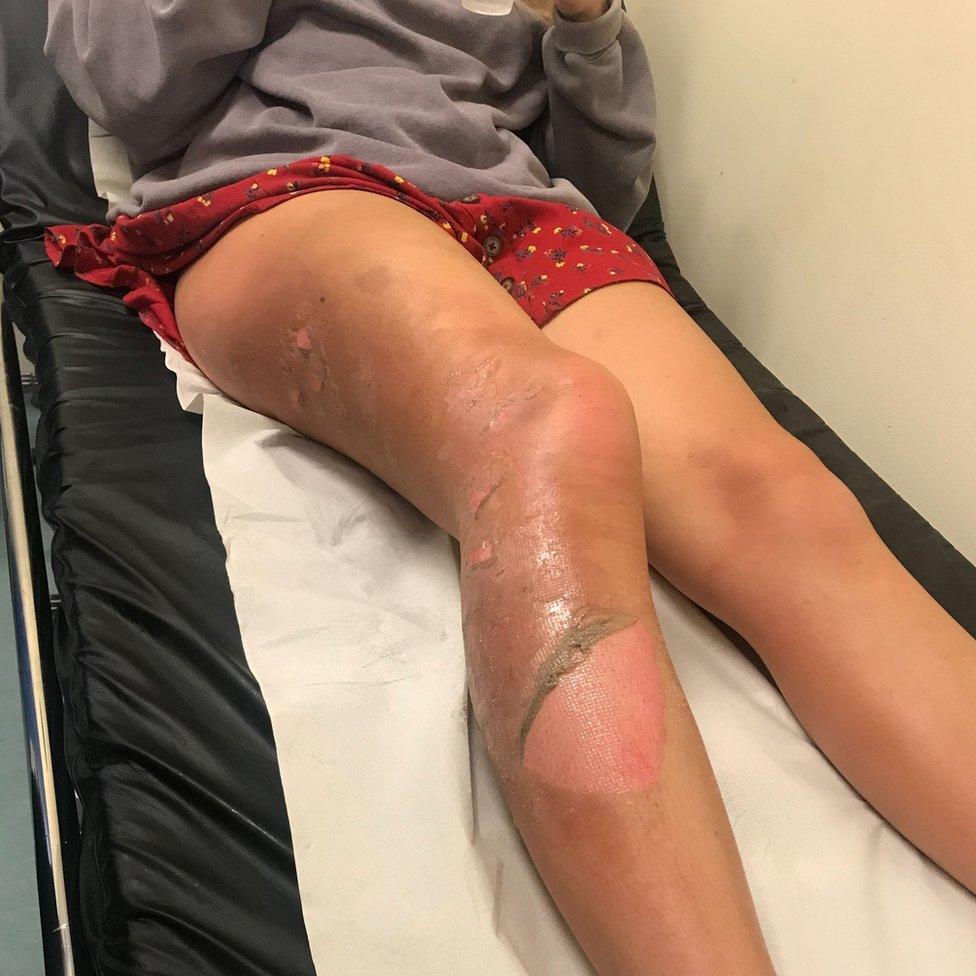 Leone Cook's burn injuries