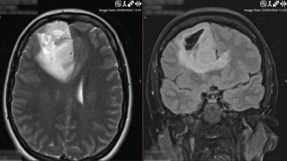 Scan image showing brain tumour