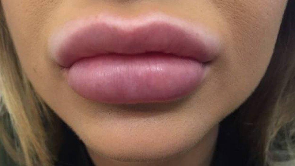 woman with overfilled lips