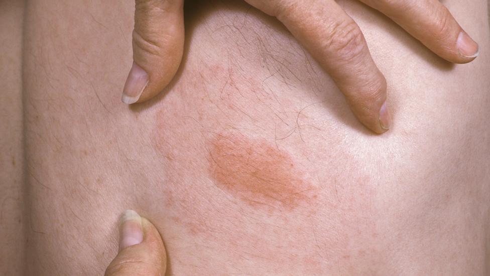 Bull's eye rash is a symptom of Lyme disease