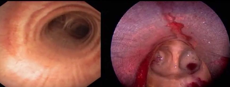 Bronchoscopy footage