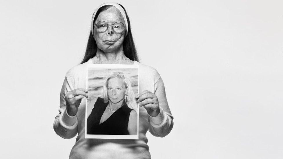 Belgian acid attack survivor and activist Patricia Lefranc