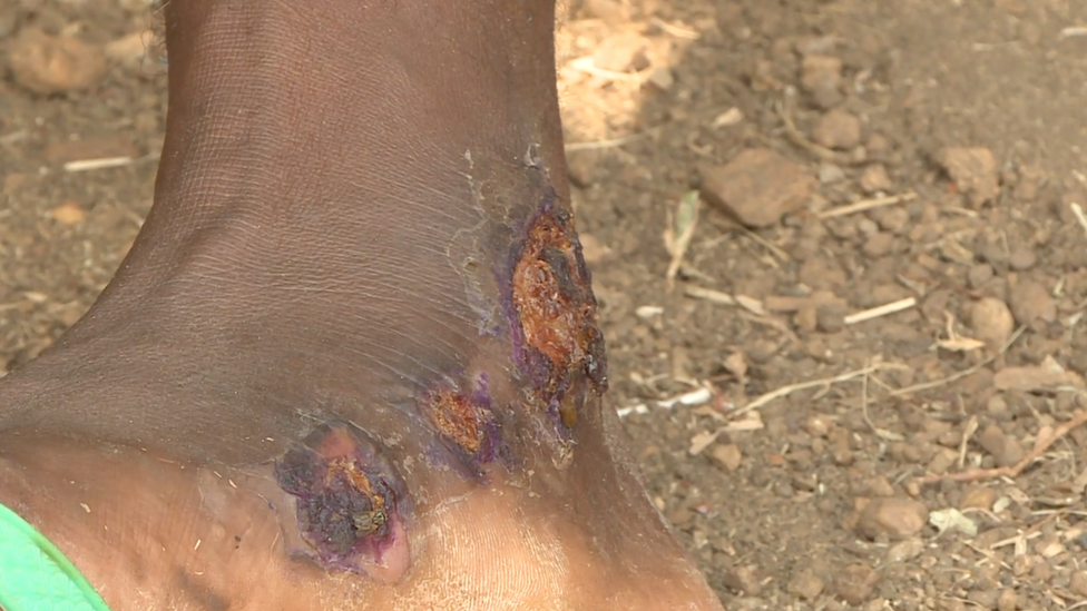 A close-up picture of Rene's wounded foot, which is heavily scabbed