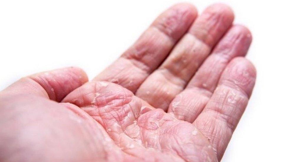 Eczema