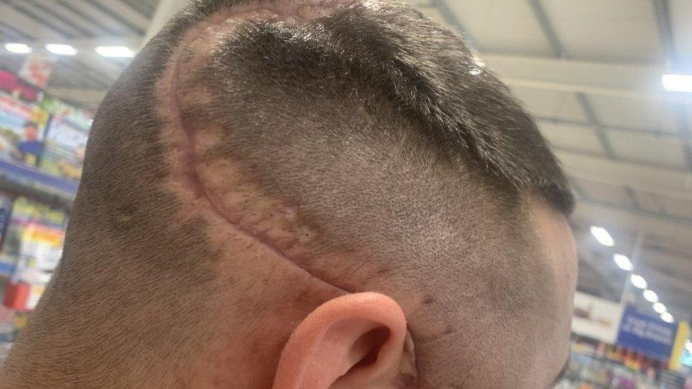 Scar on Perry Cranston's head