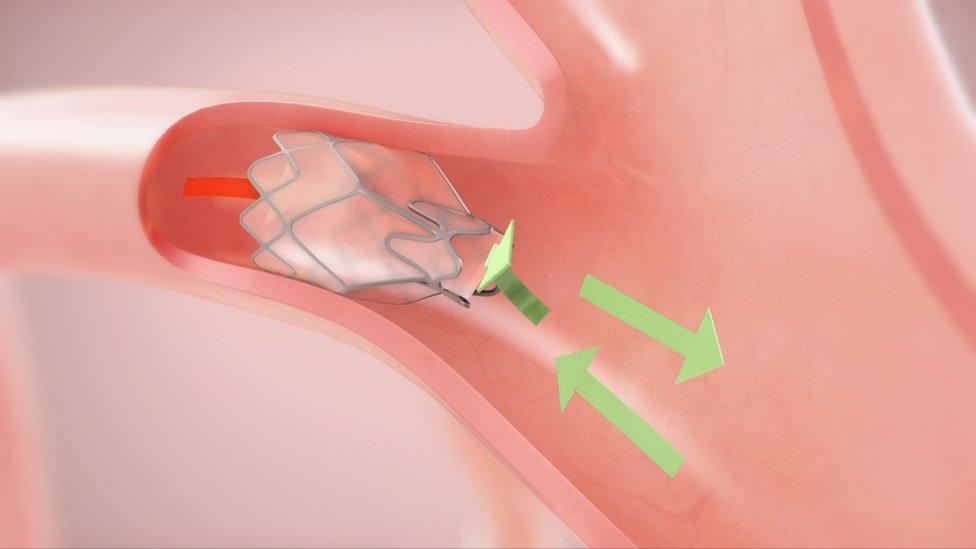 lung valves