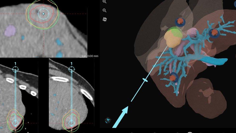 Scan image with liver tumour outlined