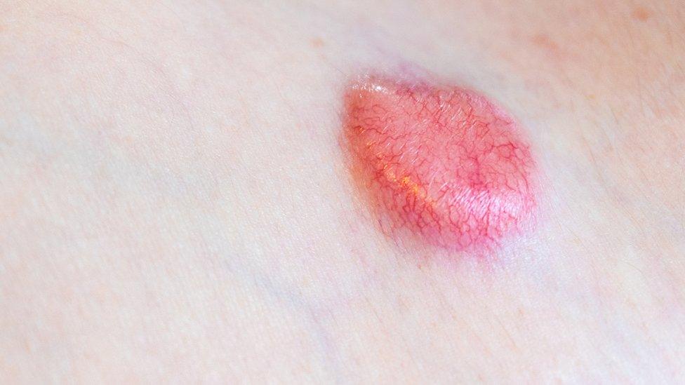 non-melanoma cancer skin cancer