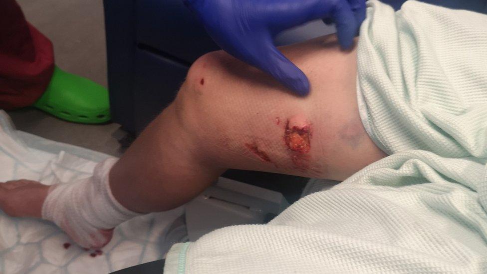 Picture of Jessica Mae Andrew's leg in hospital after she was bitten by a police dog at a rave near Bristol