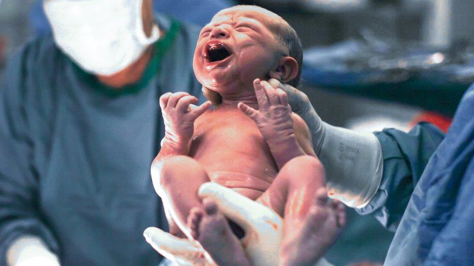 baby born by caesarean