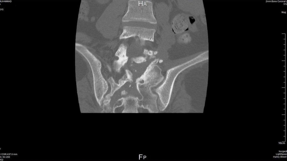 Spinal X-ray