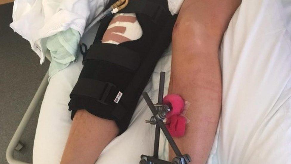 PC Claire Bond's injured legs