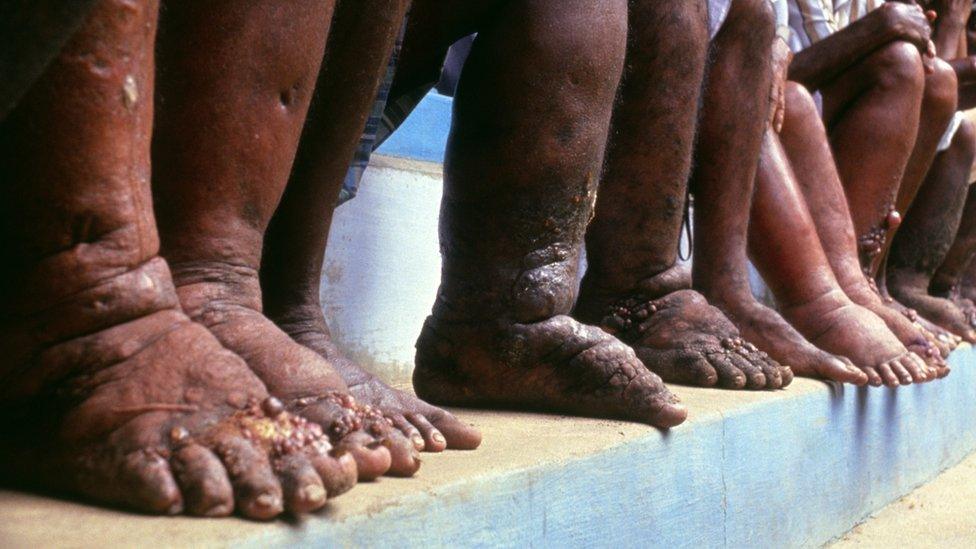 Elephantiasis