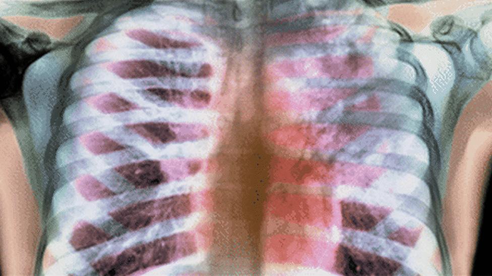 tuberculosis x-ray