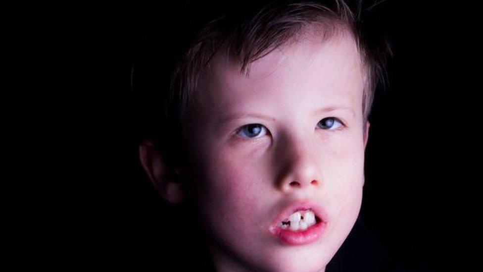 Isaac Hughes, who has Moebius syndrome