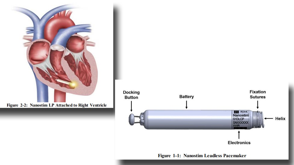 Representation of a Nanostim leadless pacemaker implanted in a heart and a close-up of the device