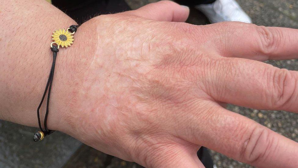 Scar on Ruth McQuillian-Wilson's hand