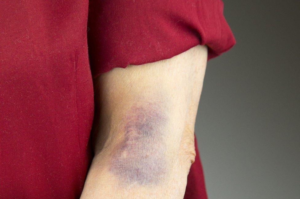 A bruise on an arm