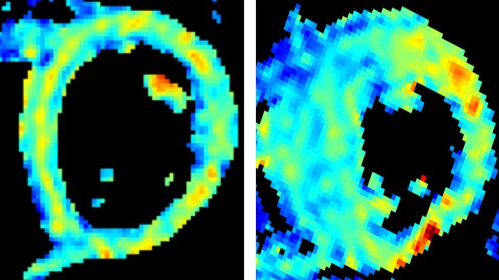 A normal, healthy heart on the left and a heart at risk on the right