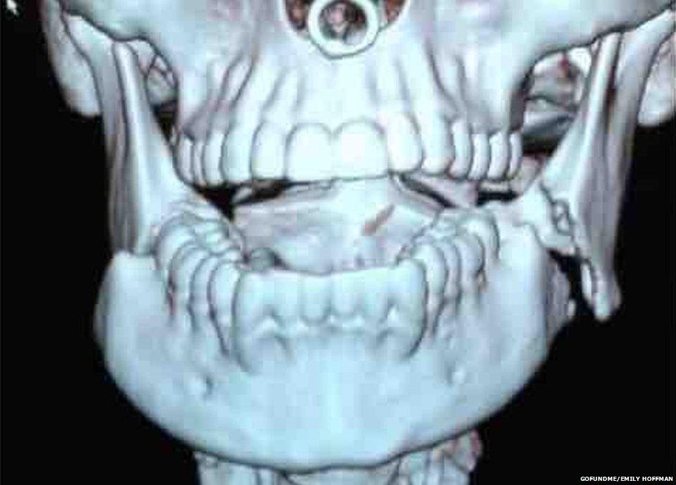 An X-ray of Emily Hoffman's jaw