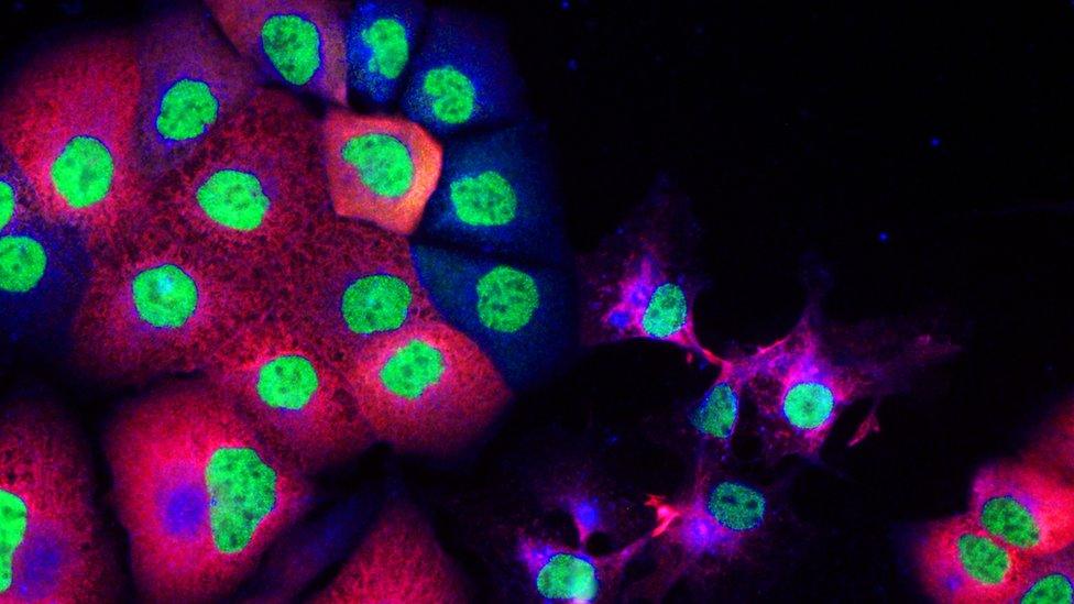 Prostate cancer cells