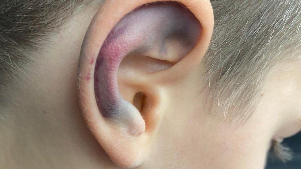 Jacob's ear