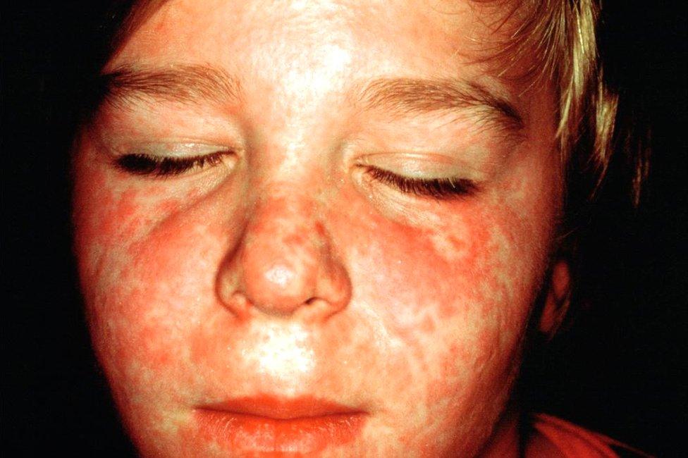 Boy with measles