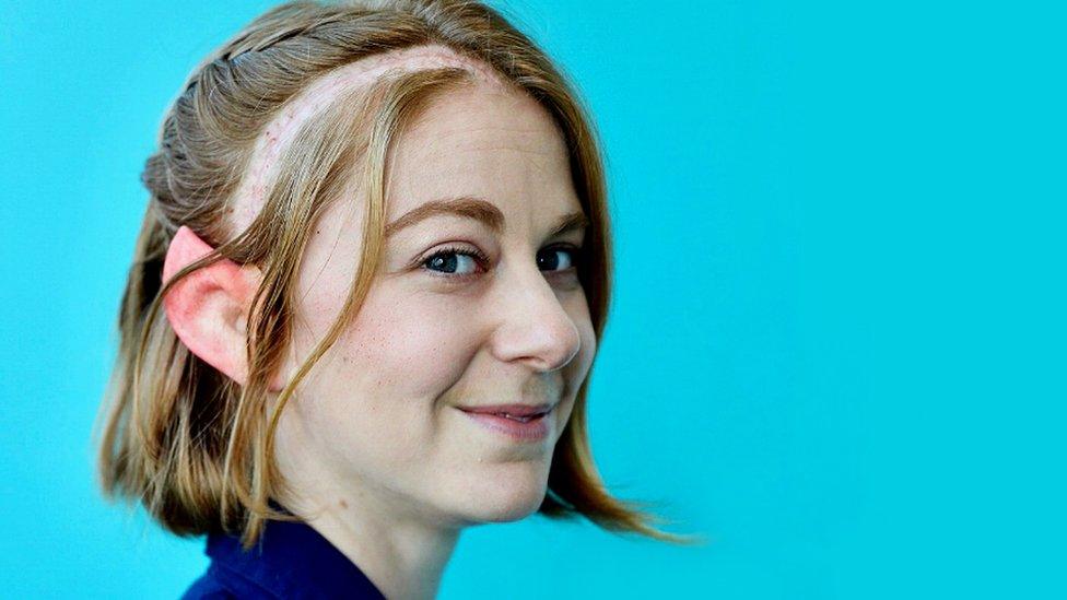 Simone Giertz showing her brain surgery scar and wearing an elf ear