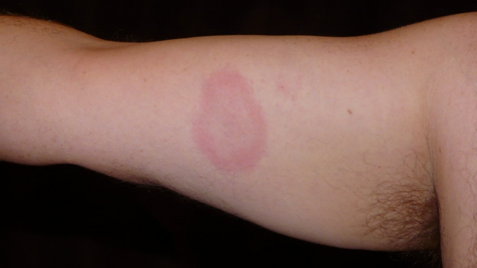 Arm with rash