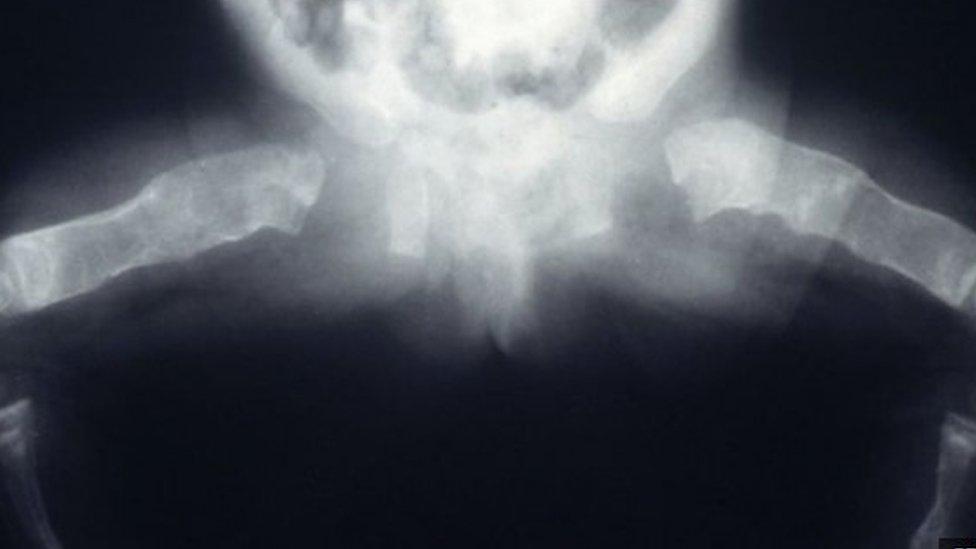 osteogenesis imperfecta